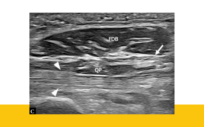 10. Musculatura intrinseca pie ecografia tempo formacion.png